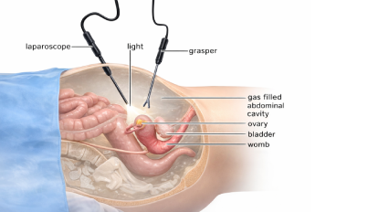 laproscopy